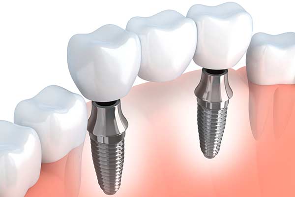 dental implants ashburn va